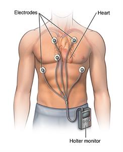 Holter monitor clipped to waistband, with electrodes attached to the chest