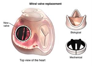 PCardio_20140401_v0_005 Mitral valve replacement showing new valve