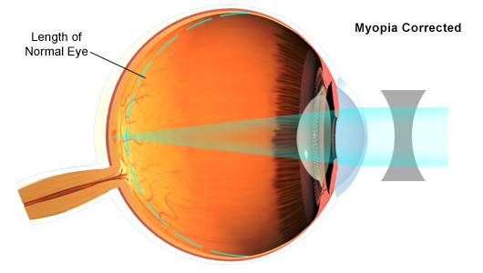 Myopia corrected