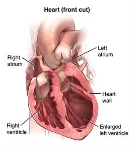 Heart (front cut), showing right and left atria, heart wall, right ventricle and enlarged left ventricle ACardio_20140403_v0_003