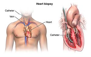 Heart biopsy PCardio_20140403_v0_005