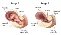Labor Stages 2 and 3