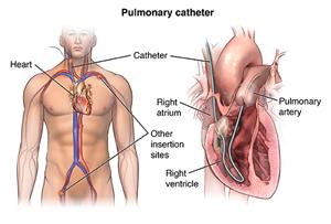 Pulmonary catheter PCardio_20140403_v0_004