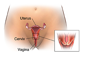 Front view of woman's pelvis showing cross section of uterus, cervix, and vagina. Inset shows closeup of cervix.
