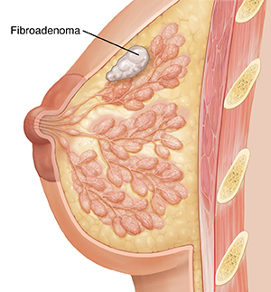 Vista lateral de un corte transversal de una mama donde se observa un fibroadenoma.