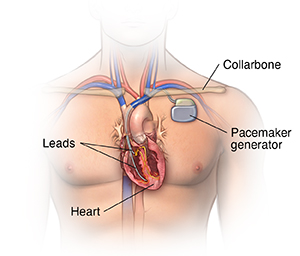 Front view of male chest showing pacemaker.