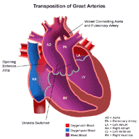 Anatomy of a heart with transposition of the great arteries