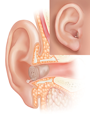 Cross section of ear showing outer ear structures with in-the-canal hearing aid in place and inset of external view.