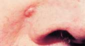 Basal cell carcinoma forms in places exposed to the sun. A lesion often looks raised, shiny, or pearly.