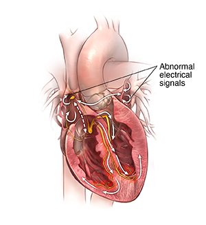 Front view cross section of heart showing atrial fibrillation.