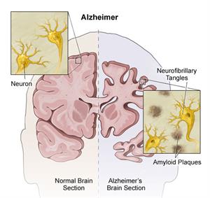 Alzheimer anatomy