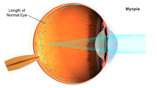 Myopia uncorrected