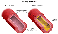 Ilustración de una tomografía dúplex de las arterias carótidas