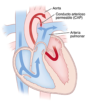 Corte transversal de vista frontal de un corazón que muestra un conducto arterioso permeable. Las flechas indican que la sangre está fluyendo a través del conducto arterioso permeable.