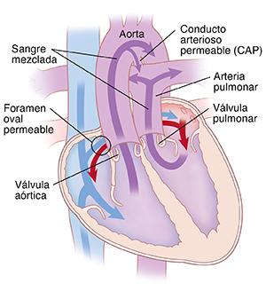 Vista de las cuatro cavidades del corazón en donde se observa las transposición de las grandes arterias. Las flechas indican que la sangre fluye a través del corazón.