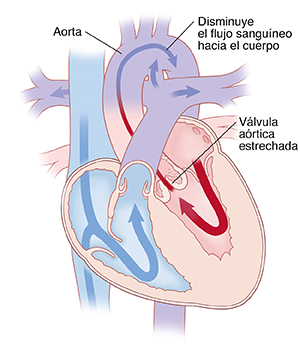 Corte transversal de vista frontal de un corazón que muestra la estenosis aórtica con flechas que indican que la sangre fluye a través del corazón.