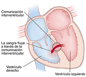 Vista de las cuatro cavidades del corazón donde se observa la comunicación intraventricular. Las flechas indican que la sangre está fluyendo a través de la comunicación interauricular desde el ventrículo izquierdo hacia el ventrículo derecho.