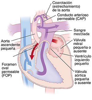 Vista de las cuatro cavidades del corazón donde se observa el síndrome de corazón izquierdo hipoplásico. Las flechas indican que la sangre fluye a través del corazón.