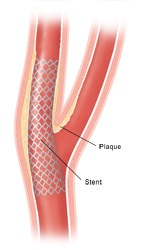 Carotid artery angioplasty with stenting